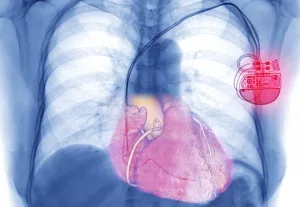Röntgenbild eines Brustkorbs mit Herzschrittmacher