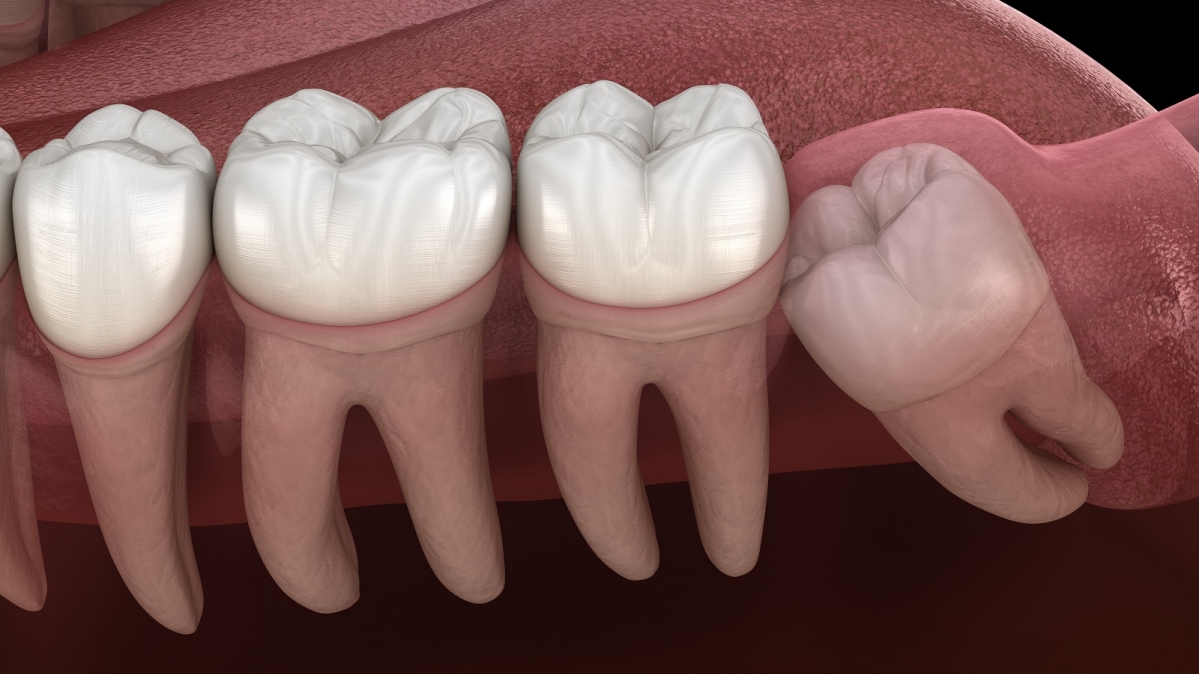 Symbolbild Weisheitszahn