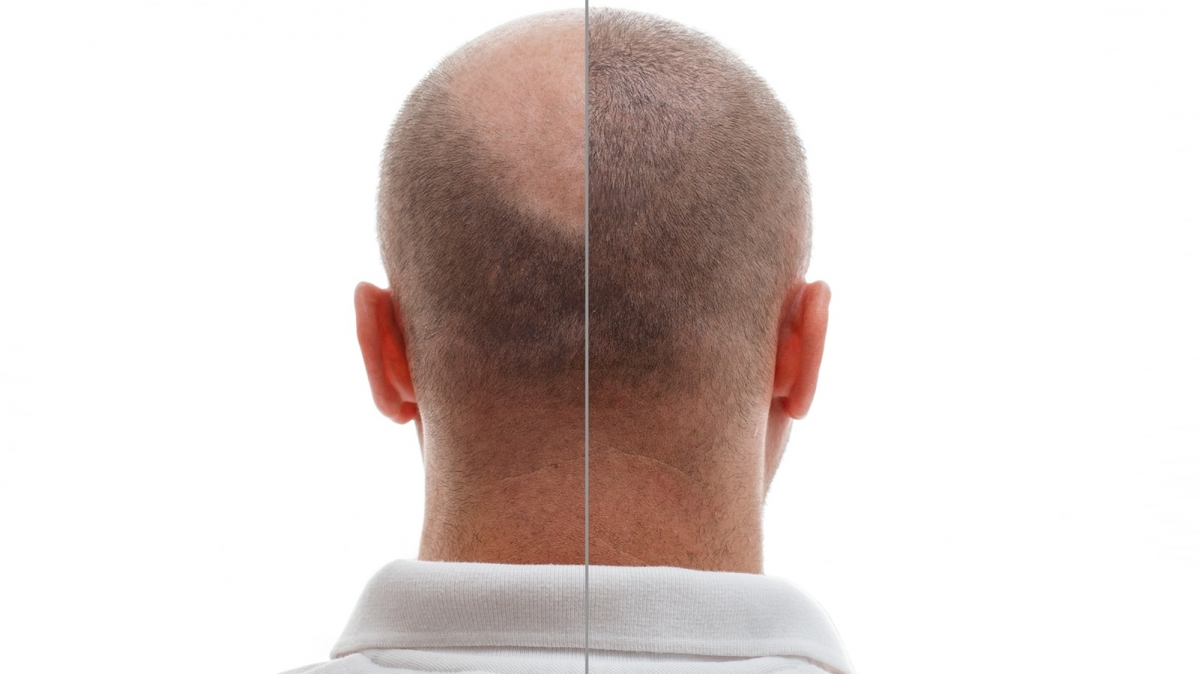 Haartransplantion Vorher-Nachher-Bild