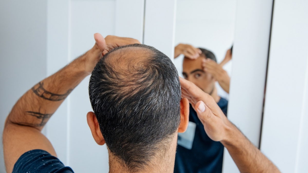 Mann mit Haarausfall vor dem Spiegel