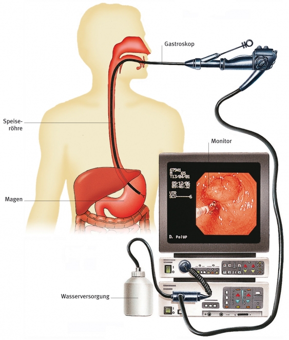 Gastroskopie, aus dem Gesundheitslexikon Gesundheit, Medizin und