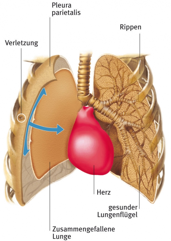 pneumothorax-aus-dem-gesundheitslexikon-gesundheit-medizin-und