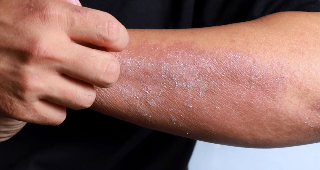 Warum kann unsere Haut jucken? wissen.de