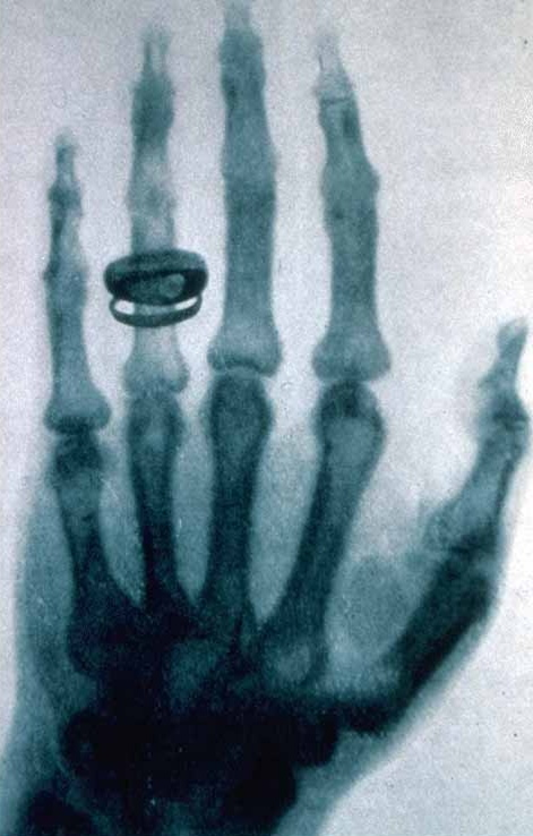 Vor 120 Jahren: Conrad Wilhelm Röntgen entdeckt die "X-Strahlung