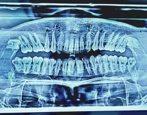 Röntgenbild eines menschlichen Kiefers mit Fehlstellungen der oberen Weisheitszähne.