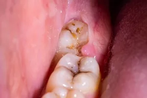 Unvollständig durchgebrochener Weisheitszahn 