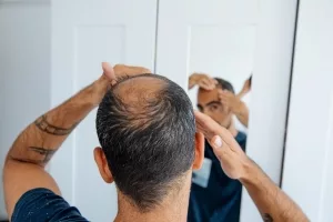 Mann mit Haarausfall für dem Spiegel