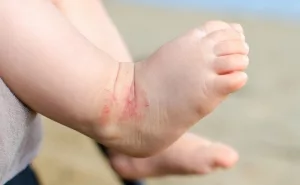 Füße eines Säuglings mit Neurodermitis