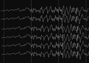 EEG mit Wechsel zu den typischen Spikes eines epileptischen Anfalls. 