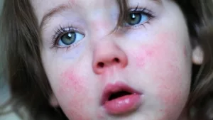Kleines Mädchen mit Scharlach-Ausschlag im Gesicht
