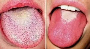 Himbeerzunge bei Scharlach