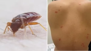 Saugende Bettwanze (r.) und Hautzustand nach Bettwanzenstichen (l.)