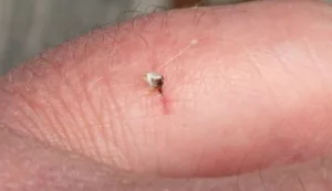 Nach einem Stich steckengebliebener Bienenstachel 