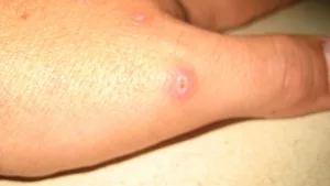 Spinnenbiss auf Höhe des Daumengrundgelenks der linken Hand