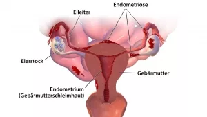 Vorkommen von Endometriose-Gewebe